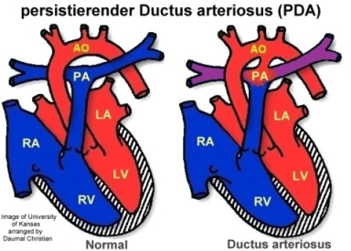 PDA