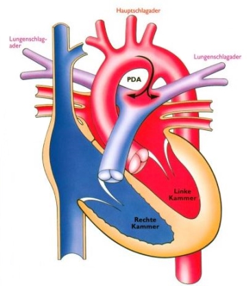 PDA Blutfluss sauerstoffgesättigt