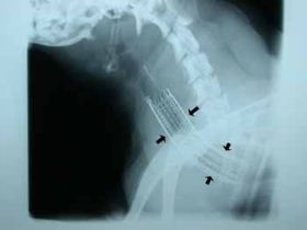 Röntgenbild Stent in Luftröhre